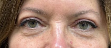 Blepharoplasty Before & After Patient #9251