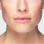 Revanesse Versa - Lips Before & After Patient #9214
