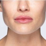 Revanesse Versa - Lips Before & After Patient #9214