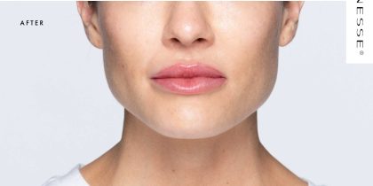 Revanesse Versa - Lips Before & After Patient #9214