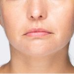 Revanesse Versa - Lips Before & After Patient #9225