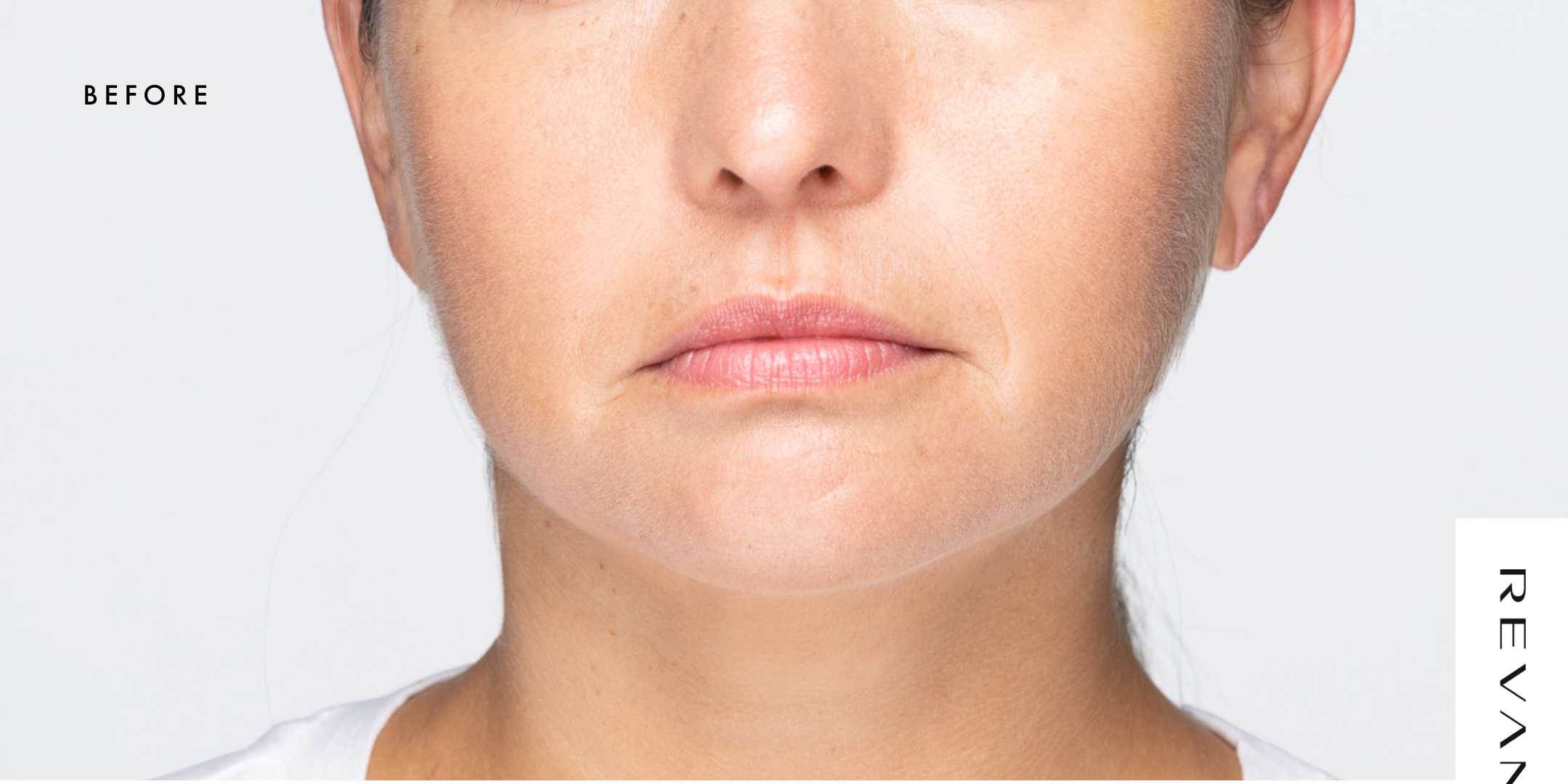 Revanesse Versa - Lips Before & After Patient #9225