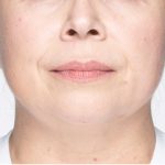 Revanesse Versa - Lips Before & After Patient #9232