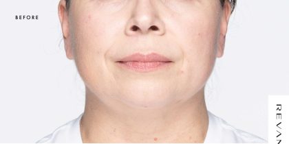 Revanesse Versa - Lips Before & After Patient #9232