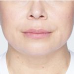 Revanesse Versa - Lips Before & After Patient #9232