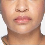 Revanesse Versa - Lips Before & After Patient #9238