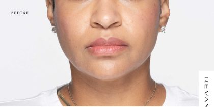 Revanesse Versa - Lips Before & After Patient #9238