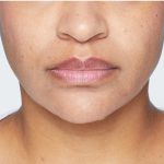 Revanesse Versa - Lips Before & After Patient #9238
