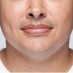 Revanesse Versa - Lips Before & After Patient #9217