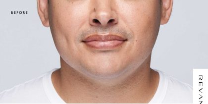 Revanesse Versa - Lips Before & After Patient #9217