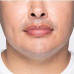 Revanesse Versa - Lips Before & After Patient #9217