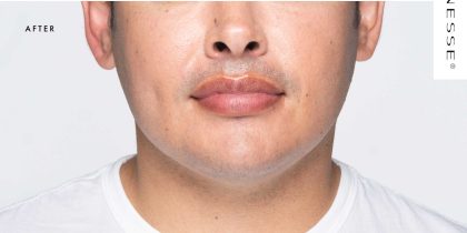 Revanesse Versa - Lips Before & After Patient #9217