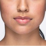 Revanesse Versa - Lips Before & After Patient #9220