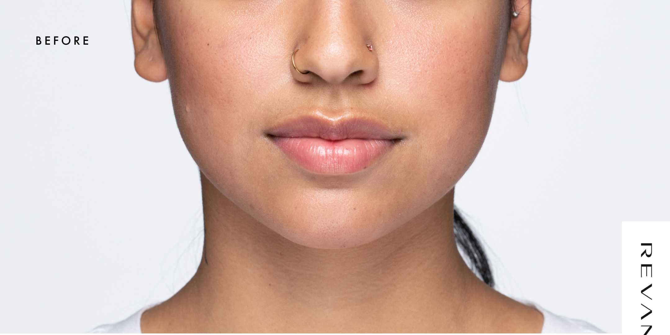 Revanesse Versa - Lips Before & After Patient #9220