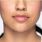 Revanesse Versa - Lips Before & After Patient #9220