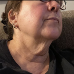 Neck Lift Before & After Patient #9649