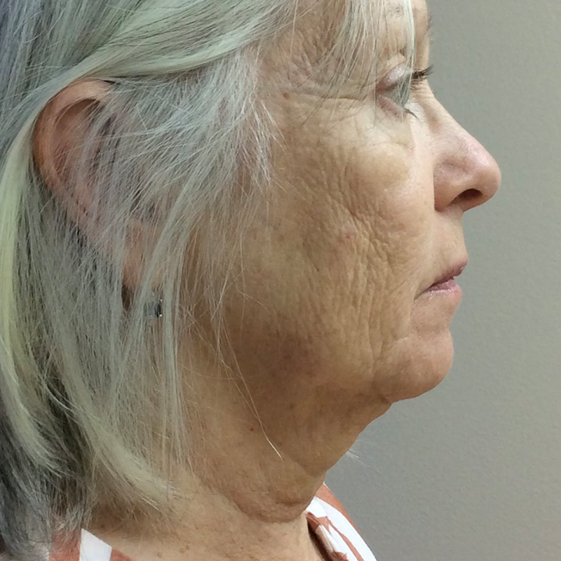 HourLift Before & After Patient #9742