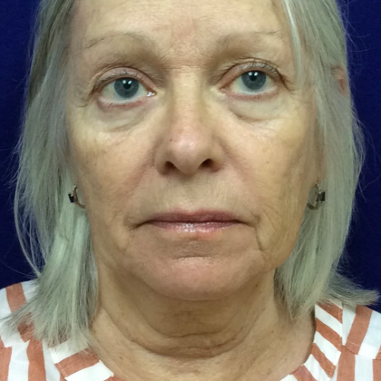 HourLift Before & After Patient #9742