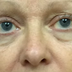 Blepharoplasty Before & After Patient #9747