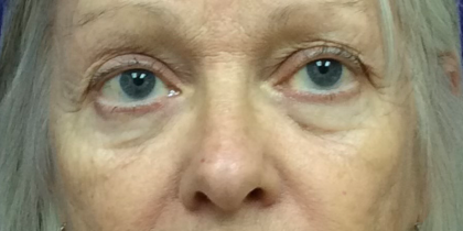 Blepharoplasty Before & After Patient #9747