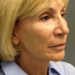 HourLift Before & After Patient #9753