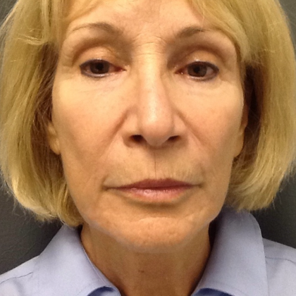 HourLift Before & After Patient #9753