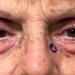 Blepharoplasty Before & After Patient #9630