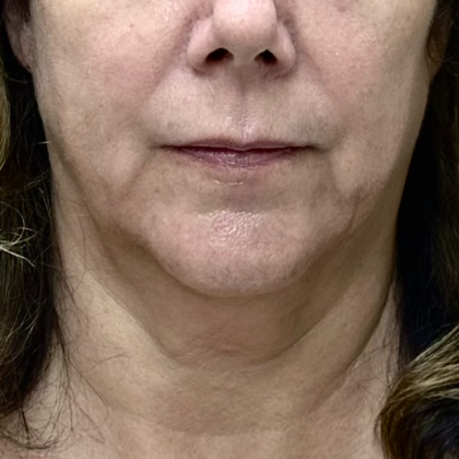 Neck Lift Before & After Patient #9766