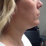 Neck Liposuction Before & After Patient #9772