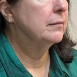 Neck Lift Before & After Patient #9652
