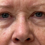 Blepharoplasty Before & After Patient #9779