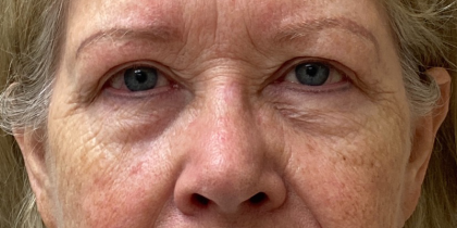 Blepharoplasty Before & After Patient #9779