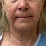 Neck Lift Before & After Patient #9801