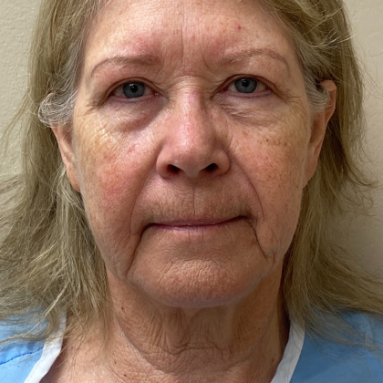 HourLift Before & After Patient #9813