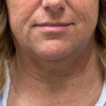 Neck Lift Before & After Patient #9885