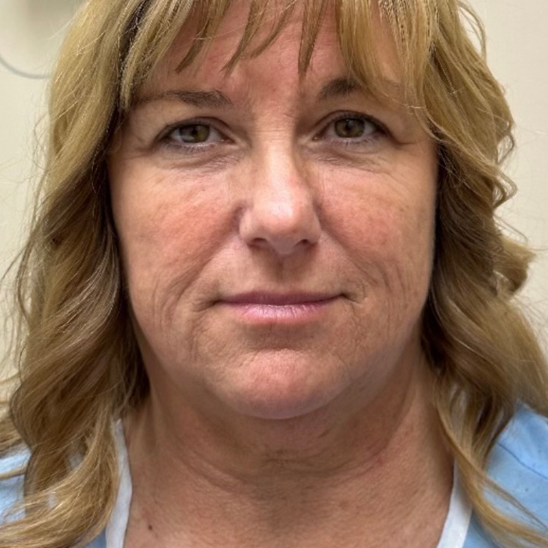 HourLift Before & After Patient #9889