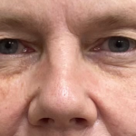 Blepharoplasty Before & After Patient #9892