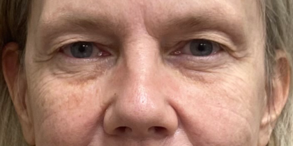Blepharoplasty Before & After Patient #9892