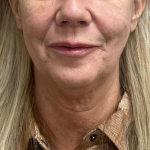 Neck Lift Before & After Patient #9899
