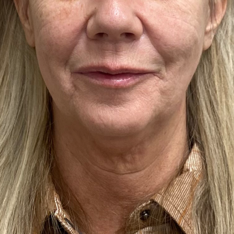 Neck Lift Before & After Patient #9899