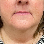 Neck Lift Before & After Patient #9716