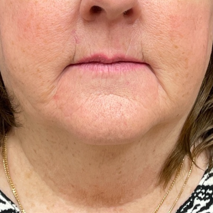 Neck Lift Before & After Patient #9716