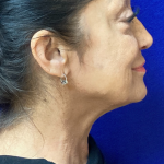 Mini Facelift Before & After Patient #9909