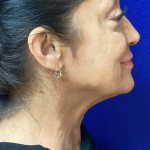 HourLift Before & After Patient #9909