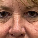 Blepharoplasty Before & After Patient #9913