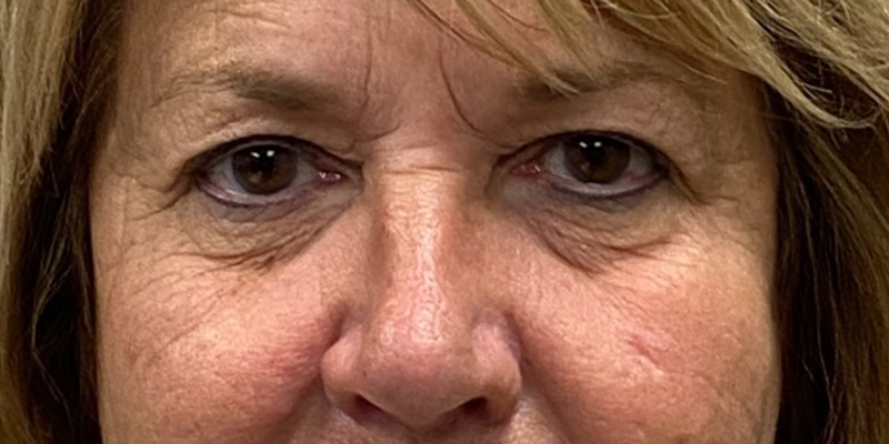 Blepharoplasty Before & After Patient #9913