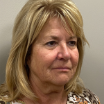 Facelift Before & After Patient #9924
