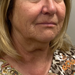 Neck Lift Before & After Patient #9929