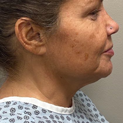 Neck Liposuction Before & After Patient #9938