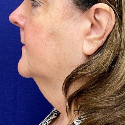 Neck Lift Before & After Patient #9720